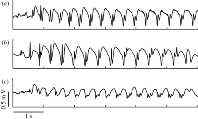 The-EEG-recordings-of-three-different-patients-with-childhood-absence-epilepsy-a-A.png